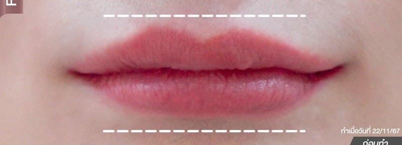 ฟิลเลอร์ปาก — เลื่อนเปรียบเทียบก่อน–หลัง — before