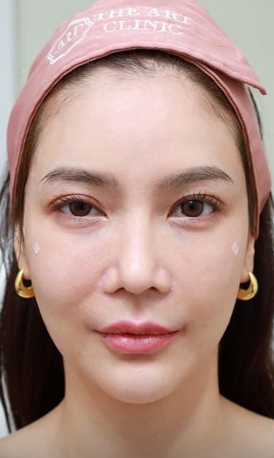 หลังทำ ฟิลเลอร์ใต้ตา + ขมับ
