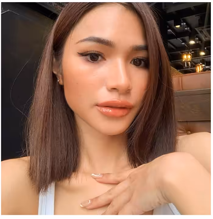 ผลลัพธ์หลังเติมฟิลเลอร์ริมฝีปาก ริมฝีปากอวบอิ่มสวยได้รูป