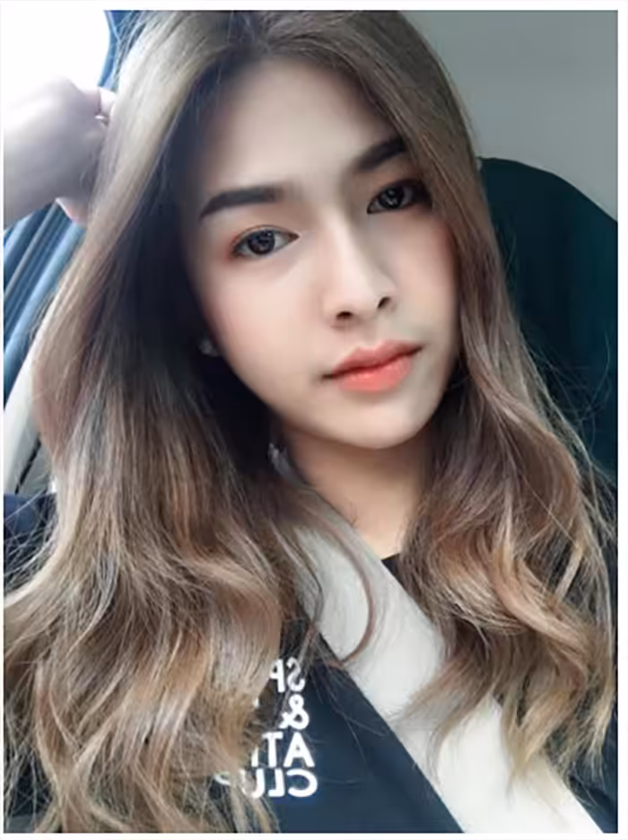 ภาพเปรียบเทียบก่อน-หลังเสริมคางเทคนิคไร้รอยต่อซิลิโคนที่ The Art