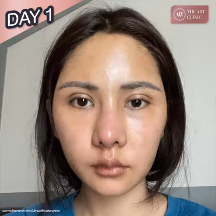 Result after facial fat transfer — fuller, plumper eye area