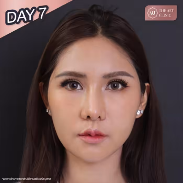 Brighter, more youthful face after under-eye fat transfer
