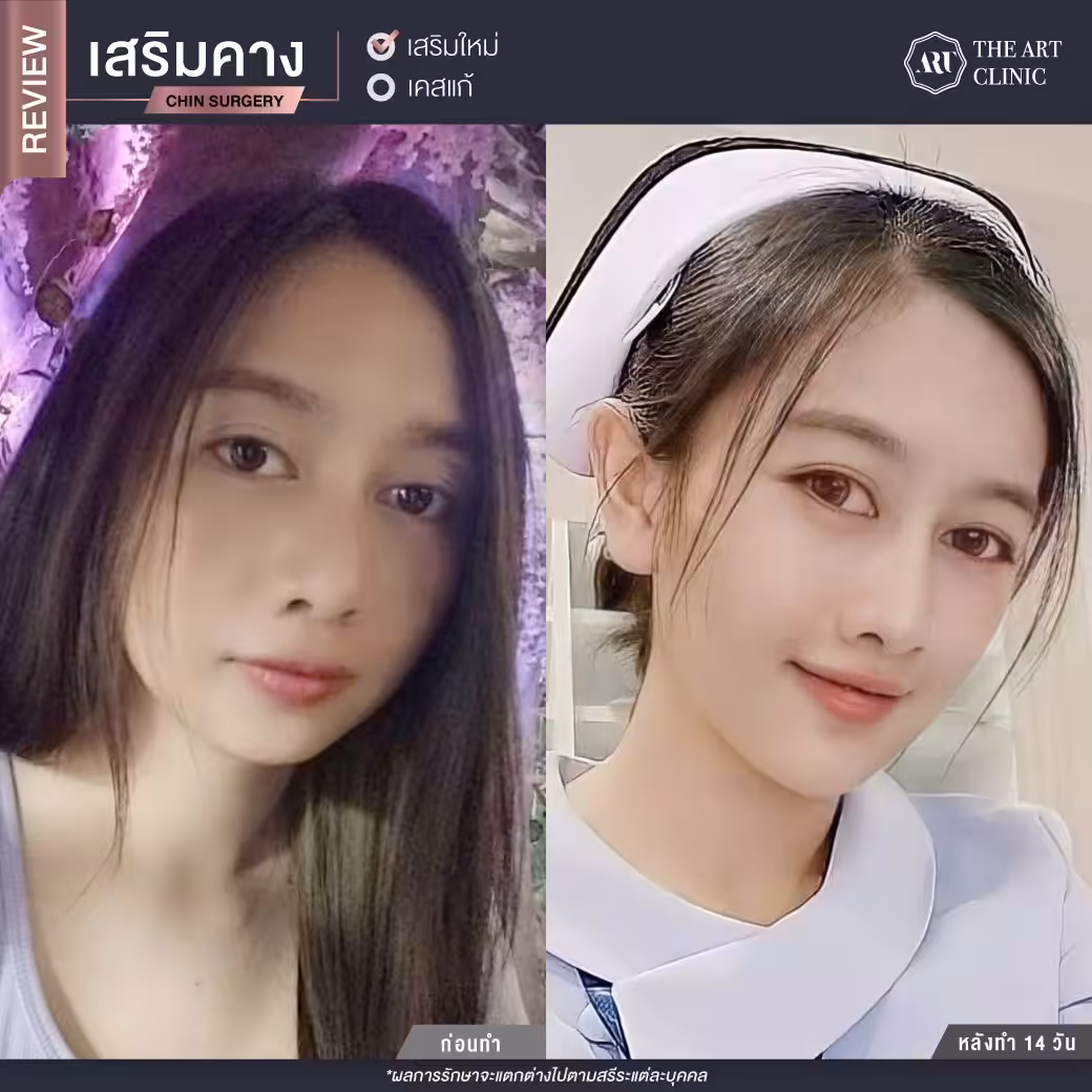 ใบหน้าไม่ได้สัดส่วน เพราะคางสั้น-คางบุ๋ม ทำหน้ากลมสั้น การทำศัลยกรรมเสริมคางช่วยทำให้ใบหน้าดูเรียวสวยได้สัดส่วนขึ้นได้