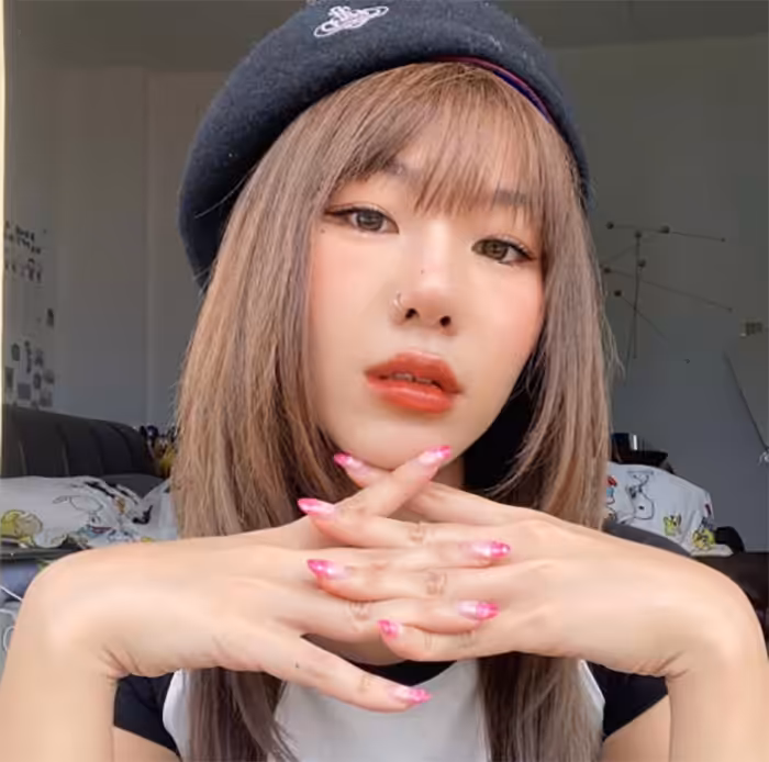 ผลลัพธ์ริมฝีปากอวบอิ่มทรงกระจับหลังฉีดฟิลเลอร์ปาก