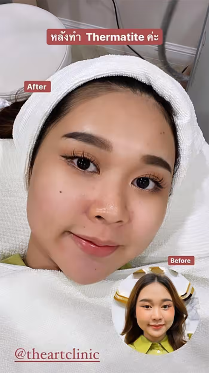 ผลลัพธ์หลังยกกระชับใบหน้าด้วย Thermatite ใบหน้าเรียวขึ้น