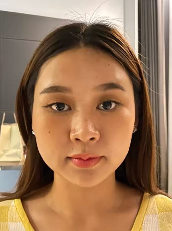 ใบหน้าดูกลมบวม เพราะเหนียงเยอะ กรอบหน้าไม่ชัด ต้องยกกระชับใบหน้าลดเซลลูไลท์แบบไม่ต้องผ่าตัดด้วยเครื่อง Thermatite ที่ “The Art”