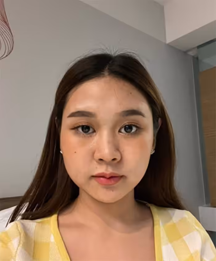 ใบหน้าก่อนทำ Thermatite กรอบหน้าไม่ชัด