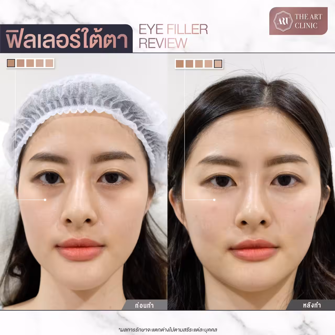 ใต้ตาลึกคล้ำ ดูแล้วตาโบ๋ทำให้ใบหน้าดูโทรมไม่สดใส แก้ไขได้ด้วยการฉีดฟิลเลอร์ใต้ตาที่ “The Art” ให้ใบหน้าดูสดใสใต้ตาตื้นขึ้น