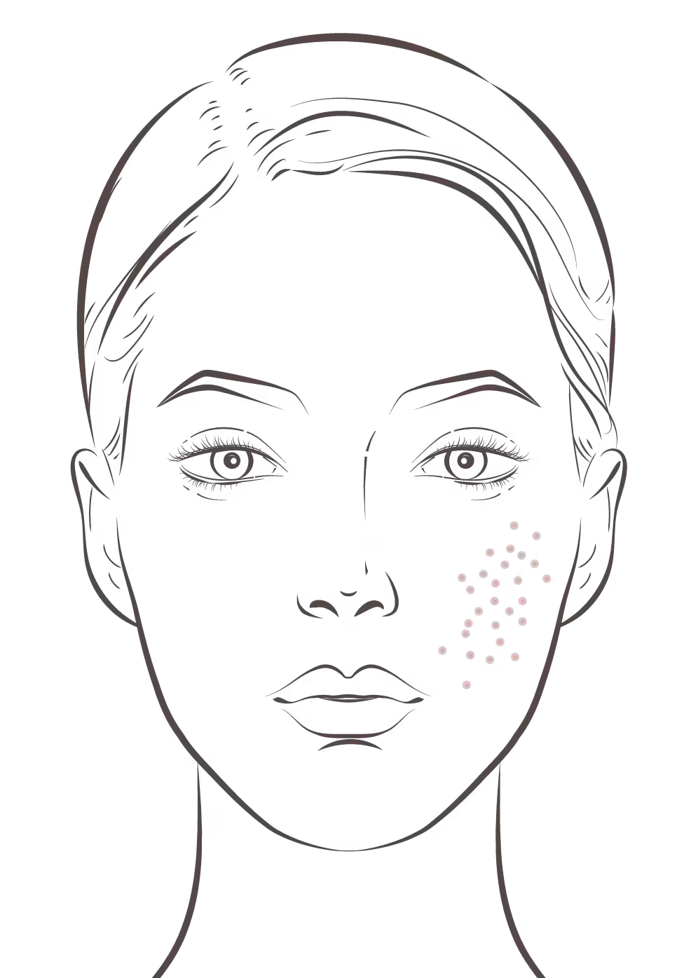 Diamond Baby Face acne scar program infographic