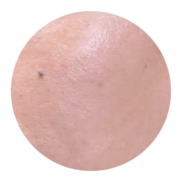Skin after the 1st Diamond Baby Face session