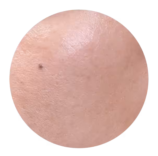 Skin after the 2nd Diamond Baby Face session