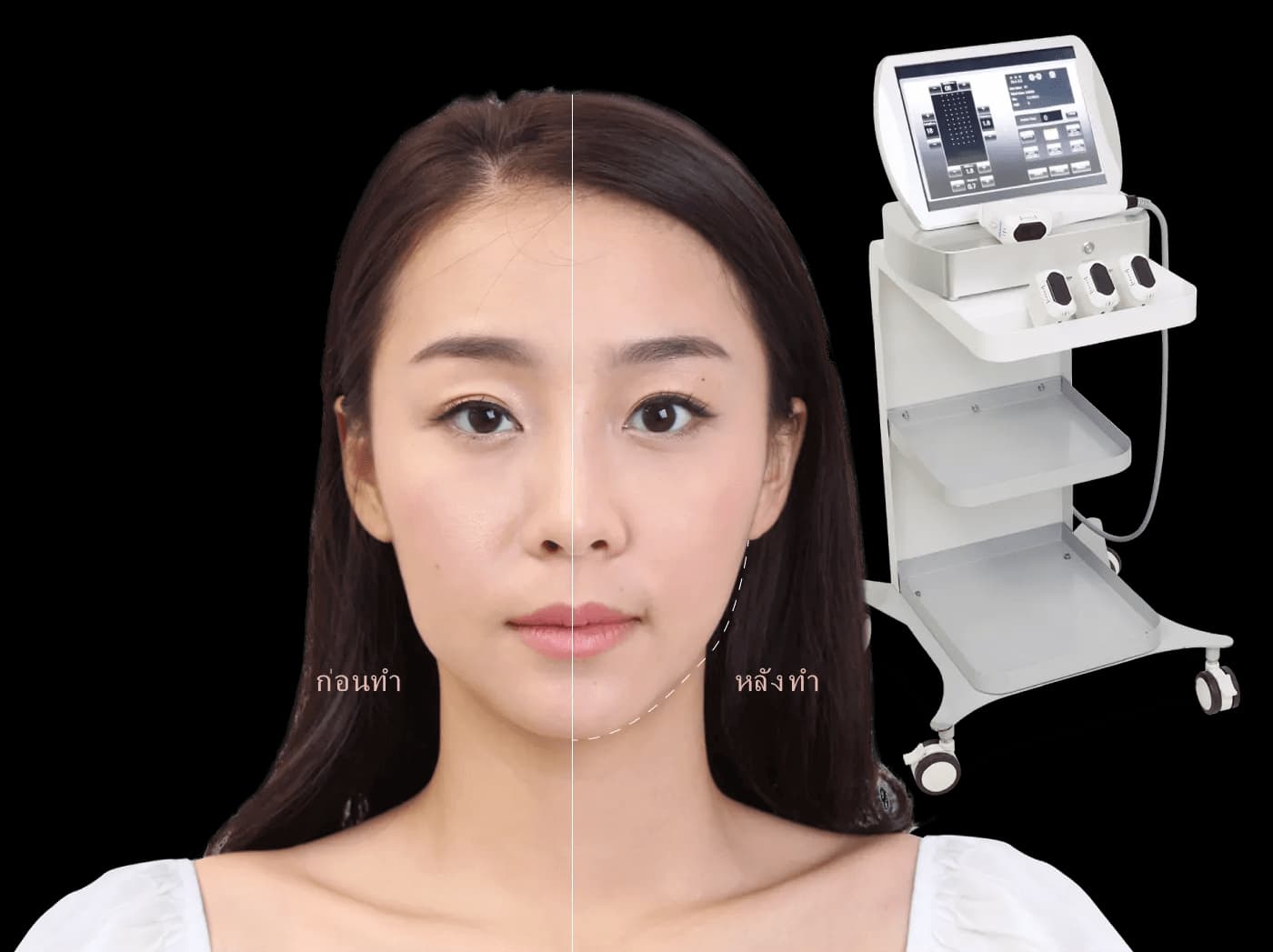 การทำงานของพลังงาน Focused Ultrasound ลงสู่ชั้นผิว SMAS