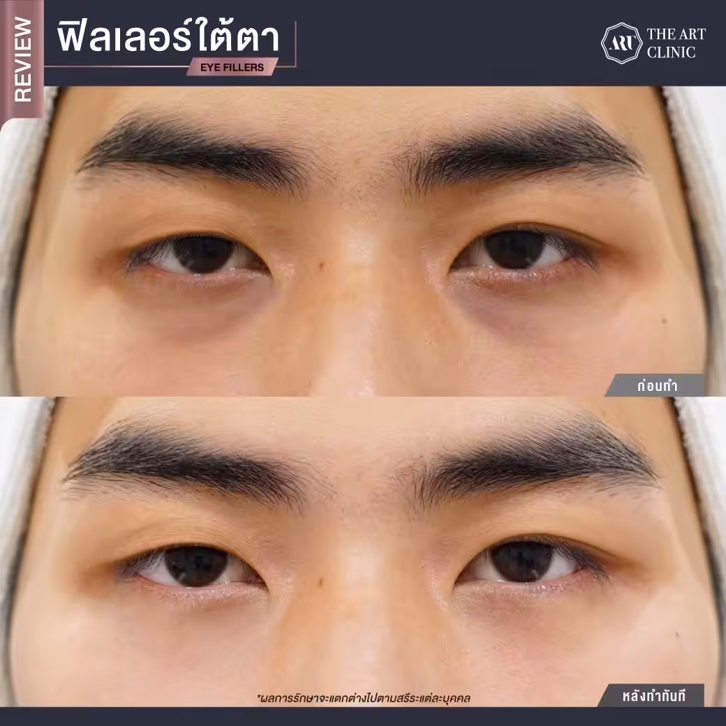 หลังฉีดฟิลเลอร์ใต้ตา