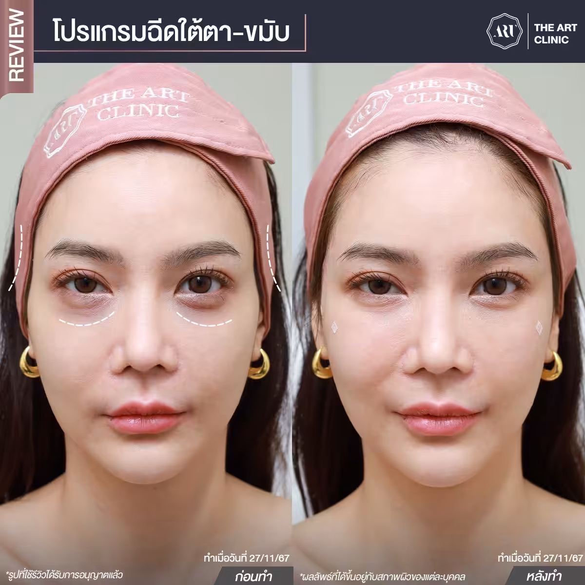 ฉีดฟิลเลอร์ใต้ตาและขมับ