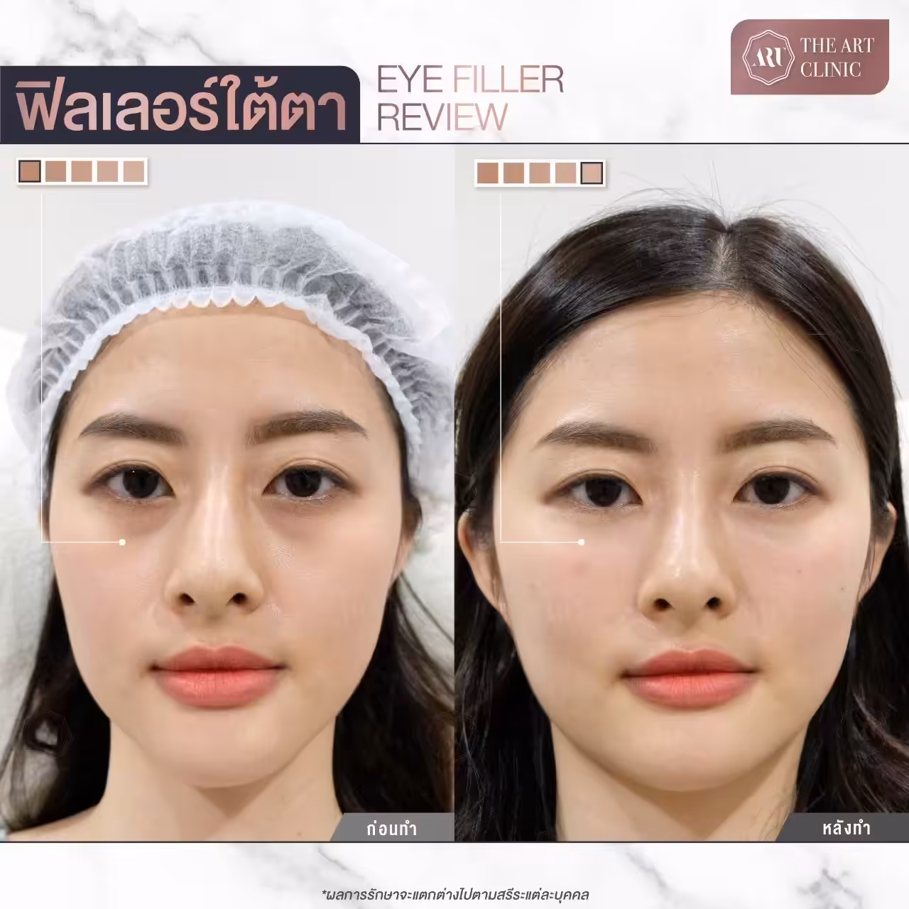 รีวิวฟิลเลอร์ใต้ตา