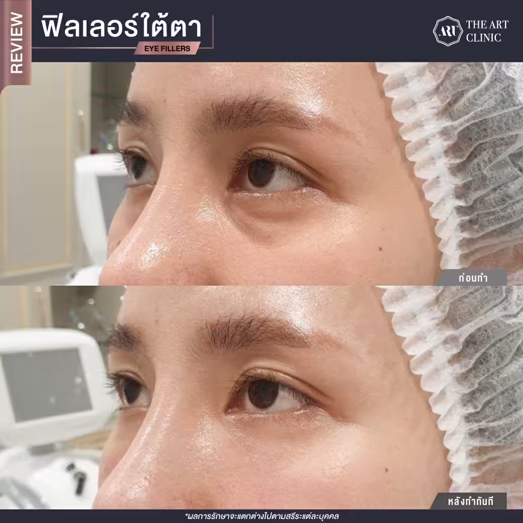 filler ใต้ตา