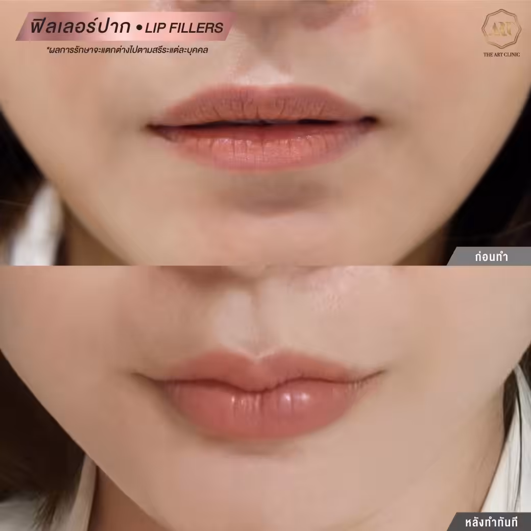 Korean-style lip filler
