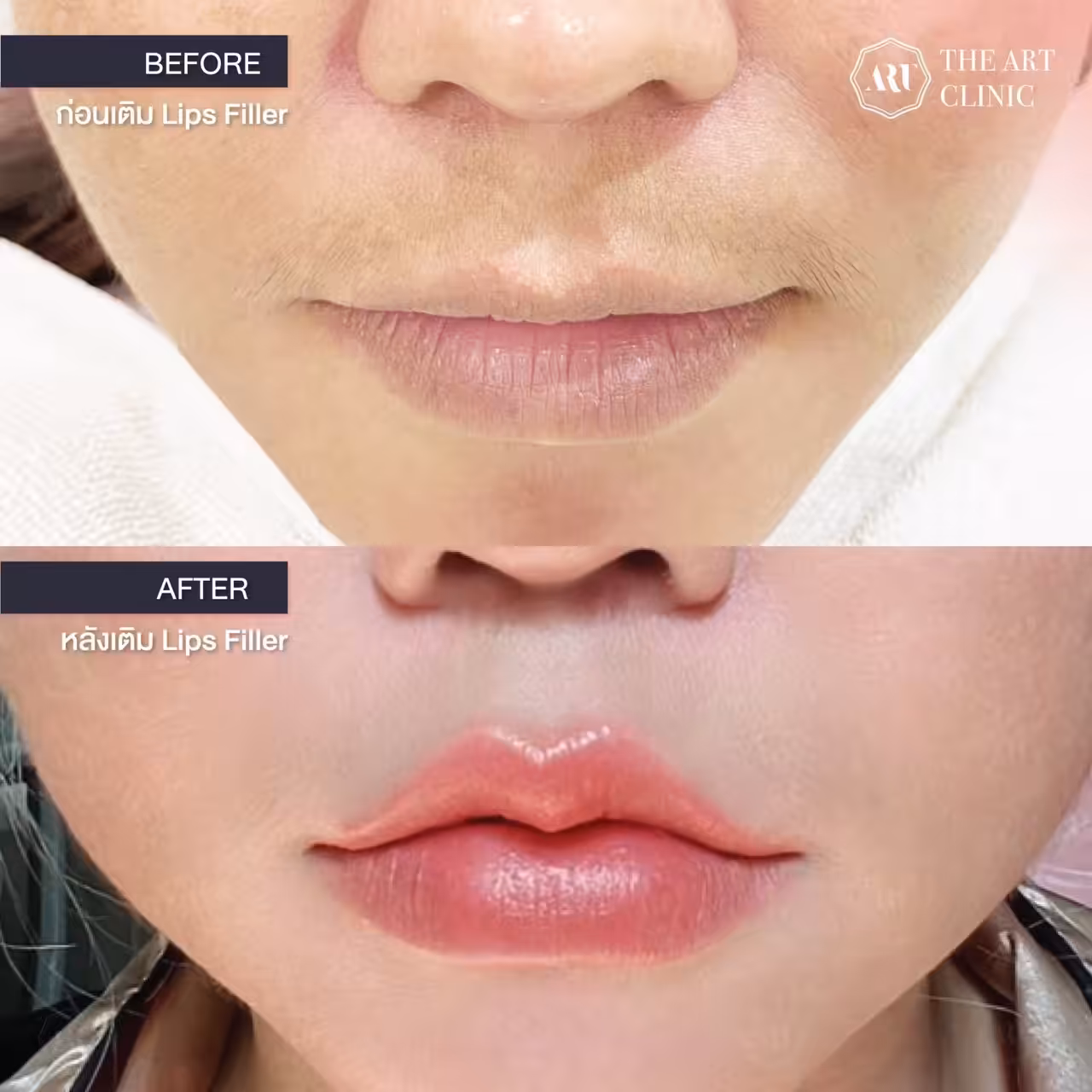 Lip filler review
