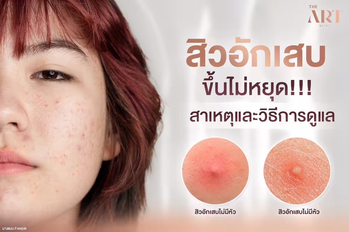 สิวอักเสบ: ศัตรูตัวร้ายบนใบหน้า