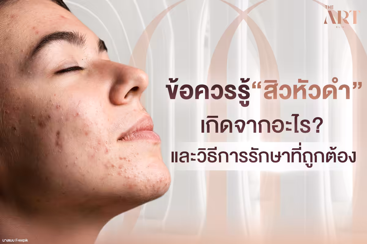 สิวหัวดำ: ปัญหาผิวที่ใครๆ ก็ไม่อยากเจอ