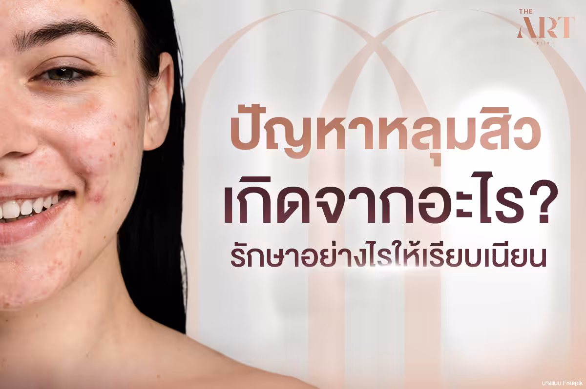 หลุมสิว: ความเข้าใจและวิธีการรักษาเพื่อผิวเรียบเนียน