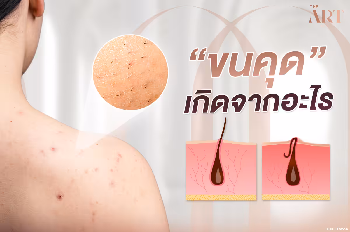 ขนคุด: สาเหตุ การรักษา และวิธีป้องกัน