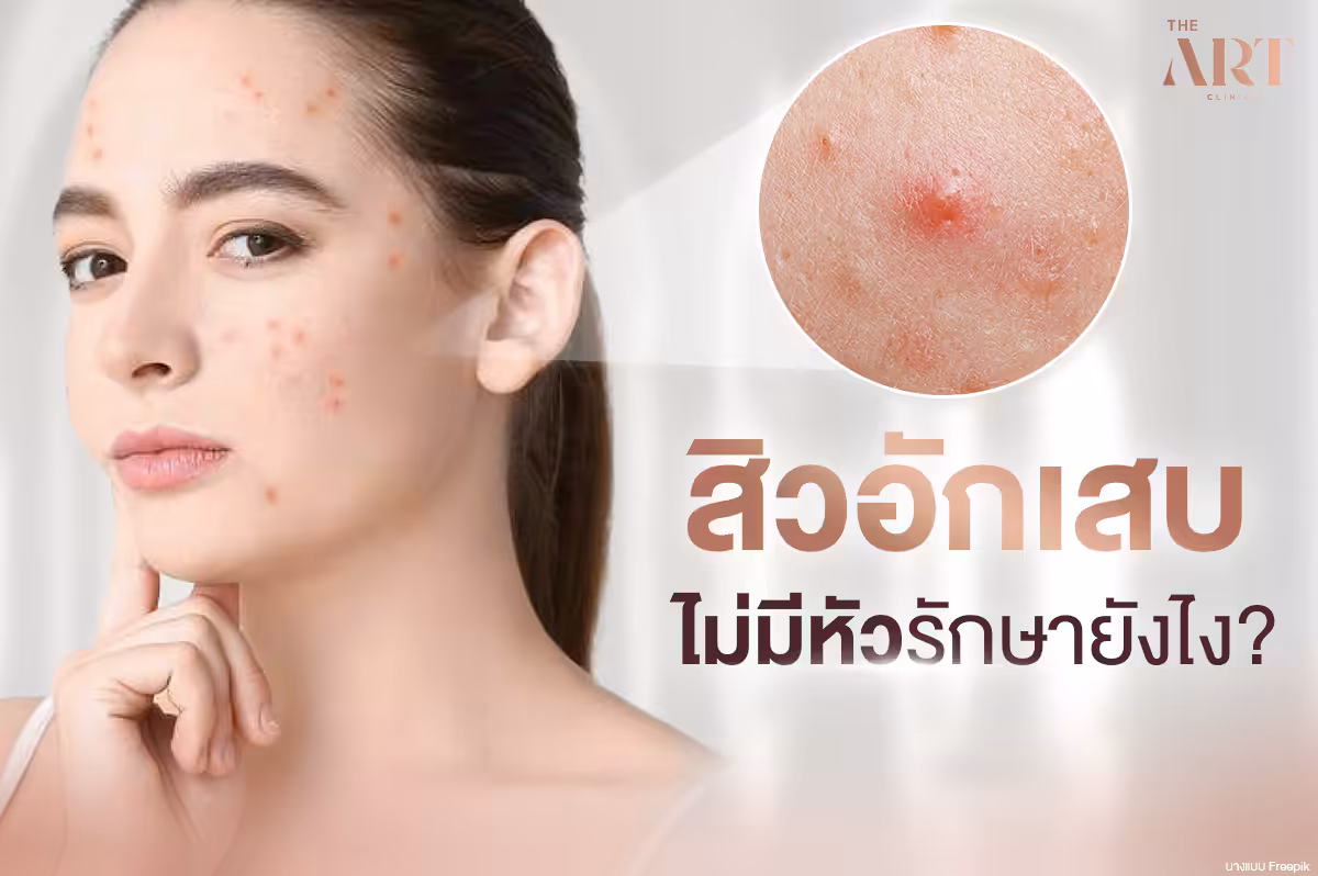ปัญหาสิวหัวช้างไม่มีหัว: ศัตรูตัวร้ายบนใบหน้า