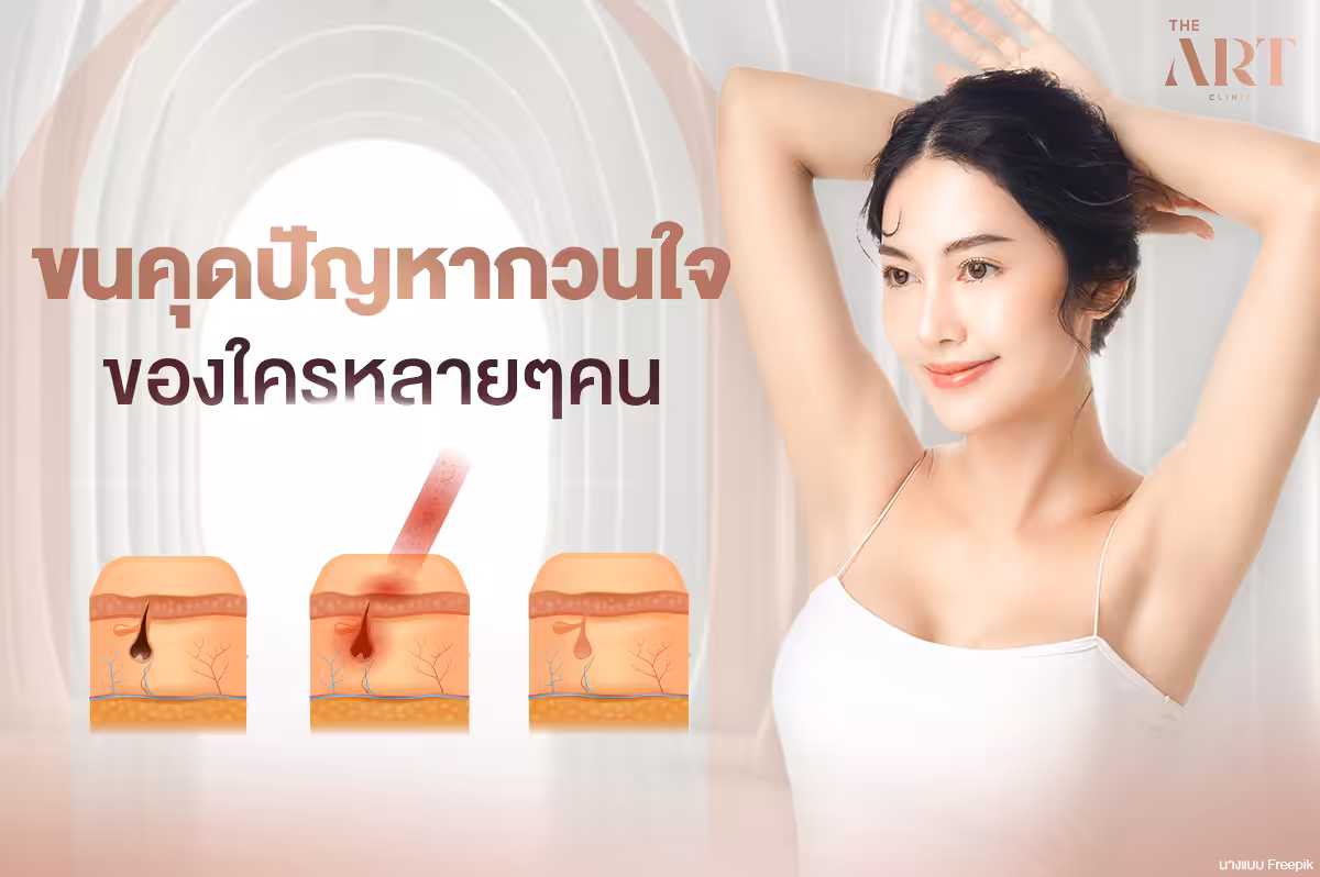 เลเซอร์ขนคุด : วิธีการกำจัดขนคุดอย่างมีประสิทธิภาพ