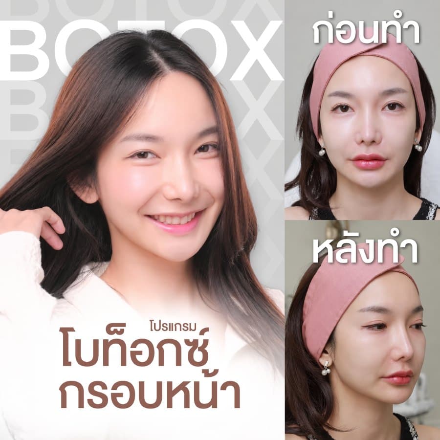 โบท็อกซ์กรอบหน้า