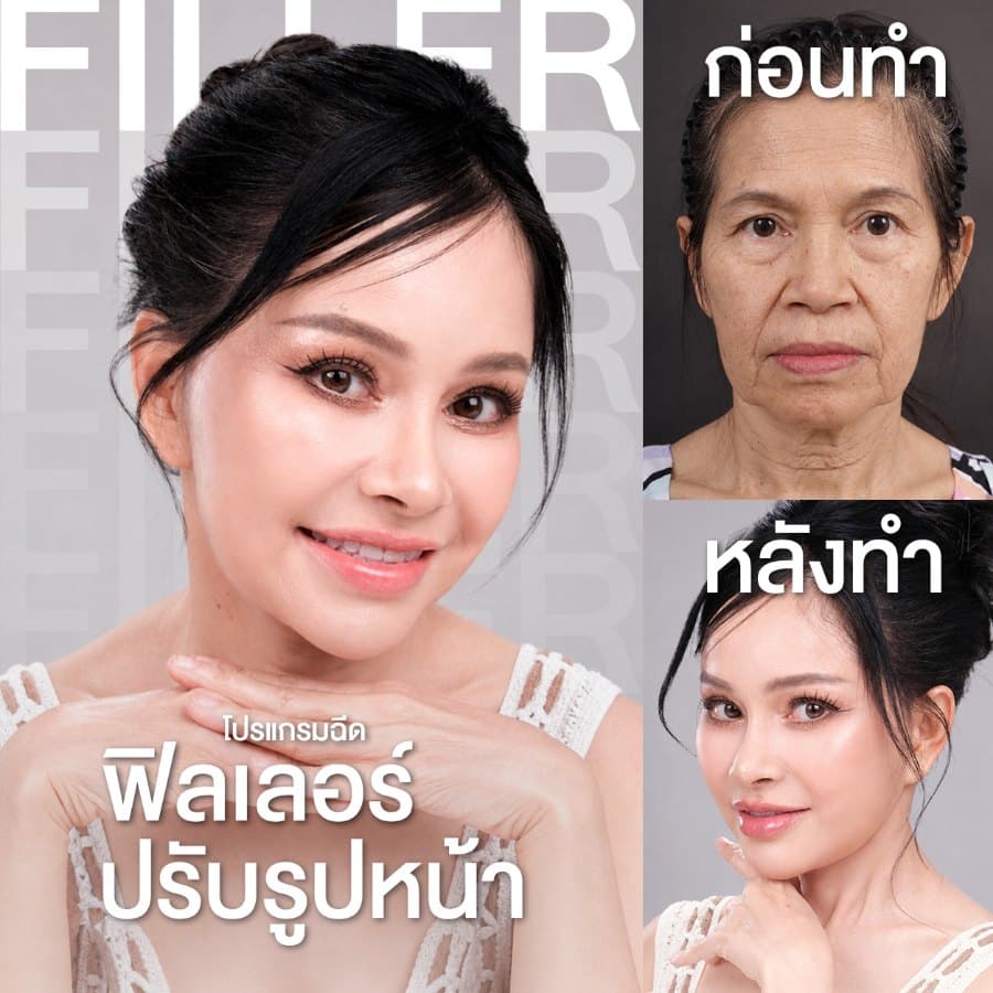 ฟิลเลอร์ปรับรูปหน้า