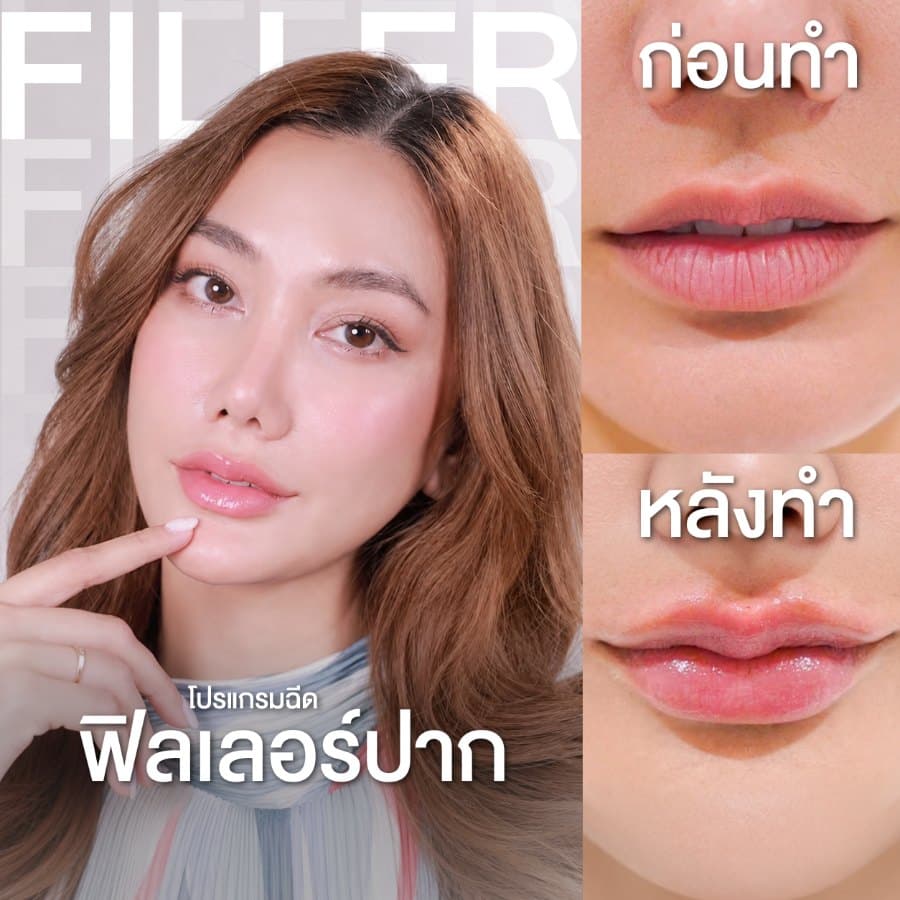 ฟิลเลอร์ปาก
