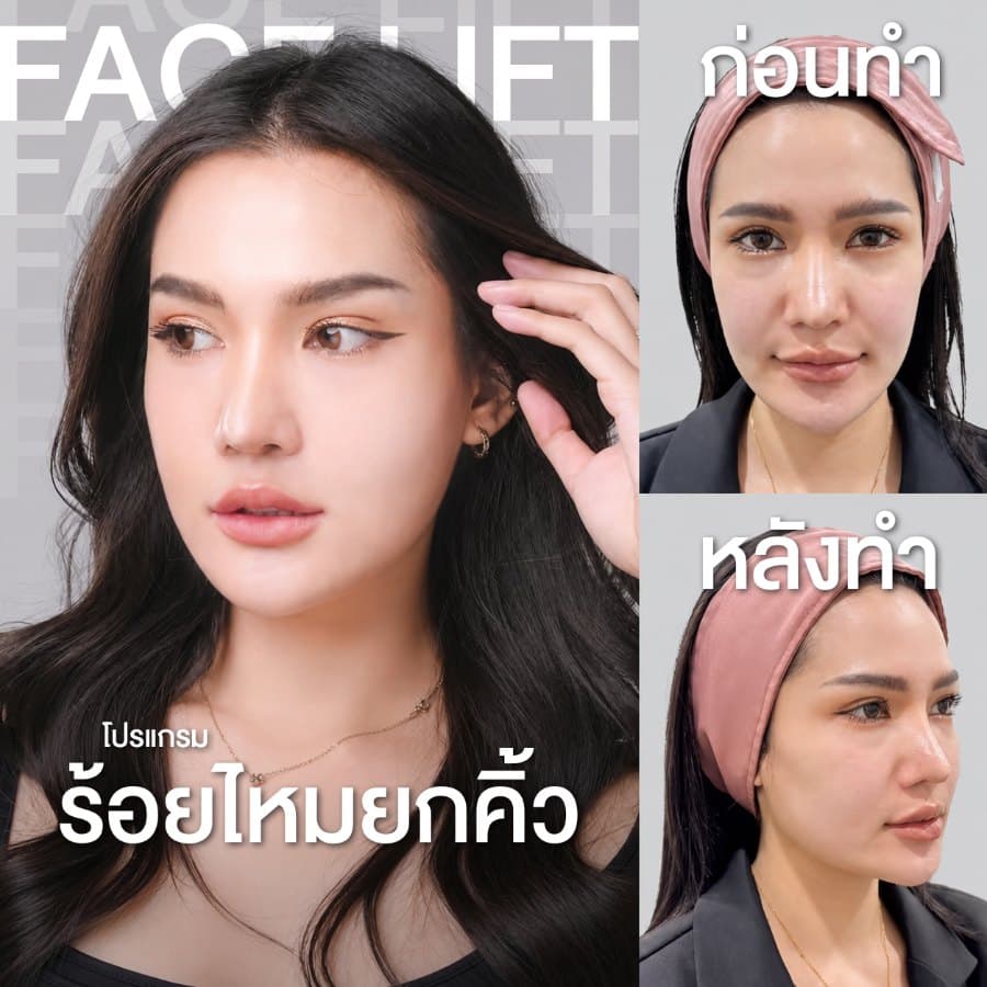 ร้อยไหมยกคิ้ว