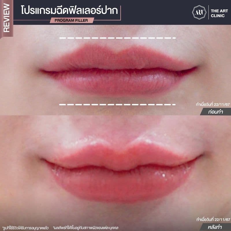 รีวิวฉีดฟิลเลอร์ เคสจริงที่ 1