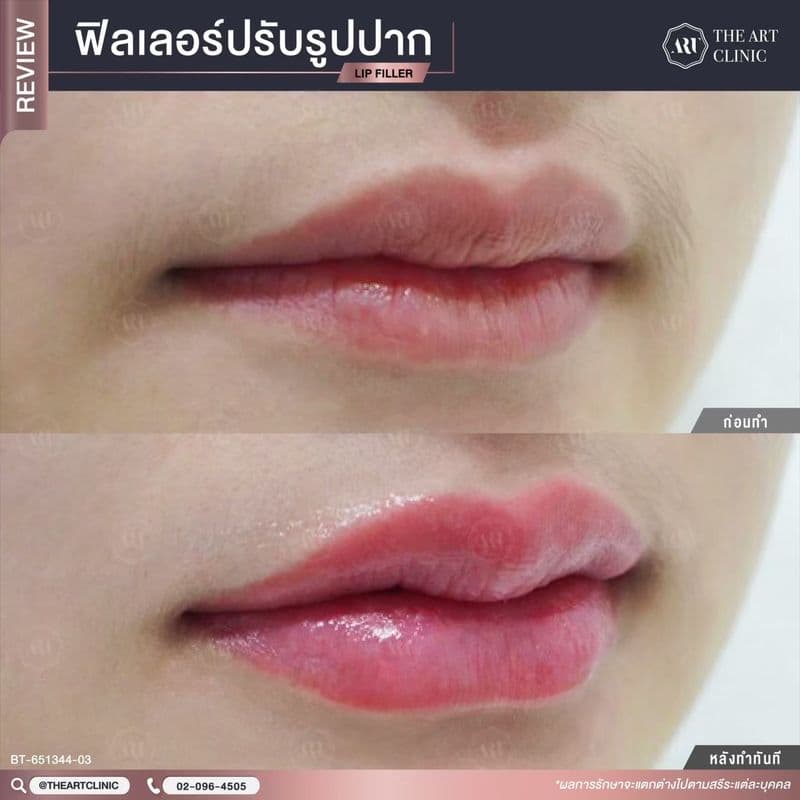 รีวิวฉีดฟิลเลอร์ เคสจริงที่ 2