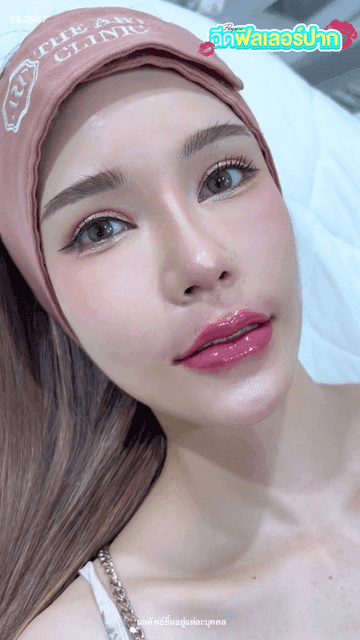 รีวิวฉีดฟิลเลอร์ปาก