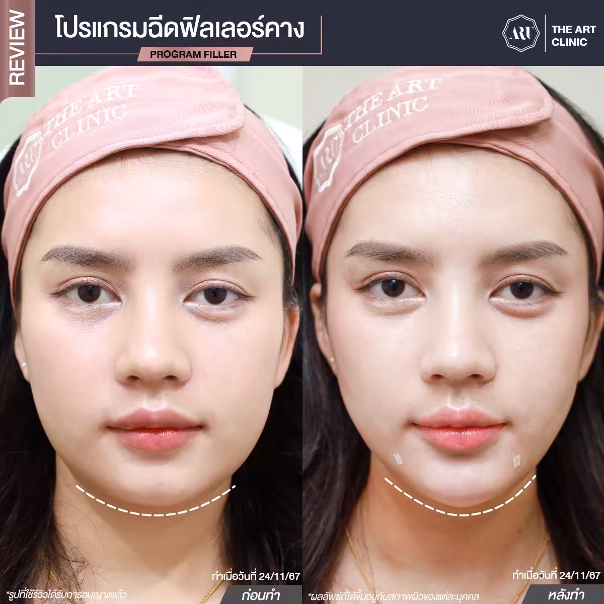 ฟิลเลอร์ปรับรูปหน้า